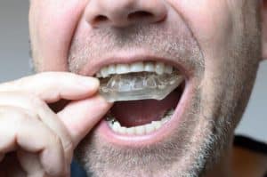 Why Are You Prescribing Bruxism Appliances?