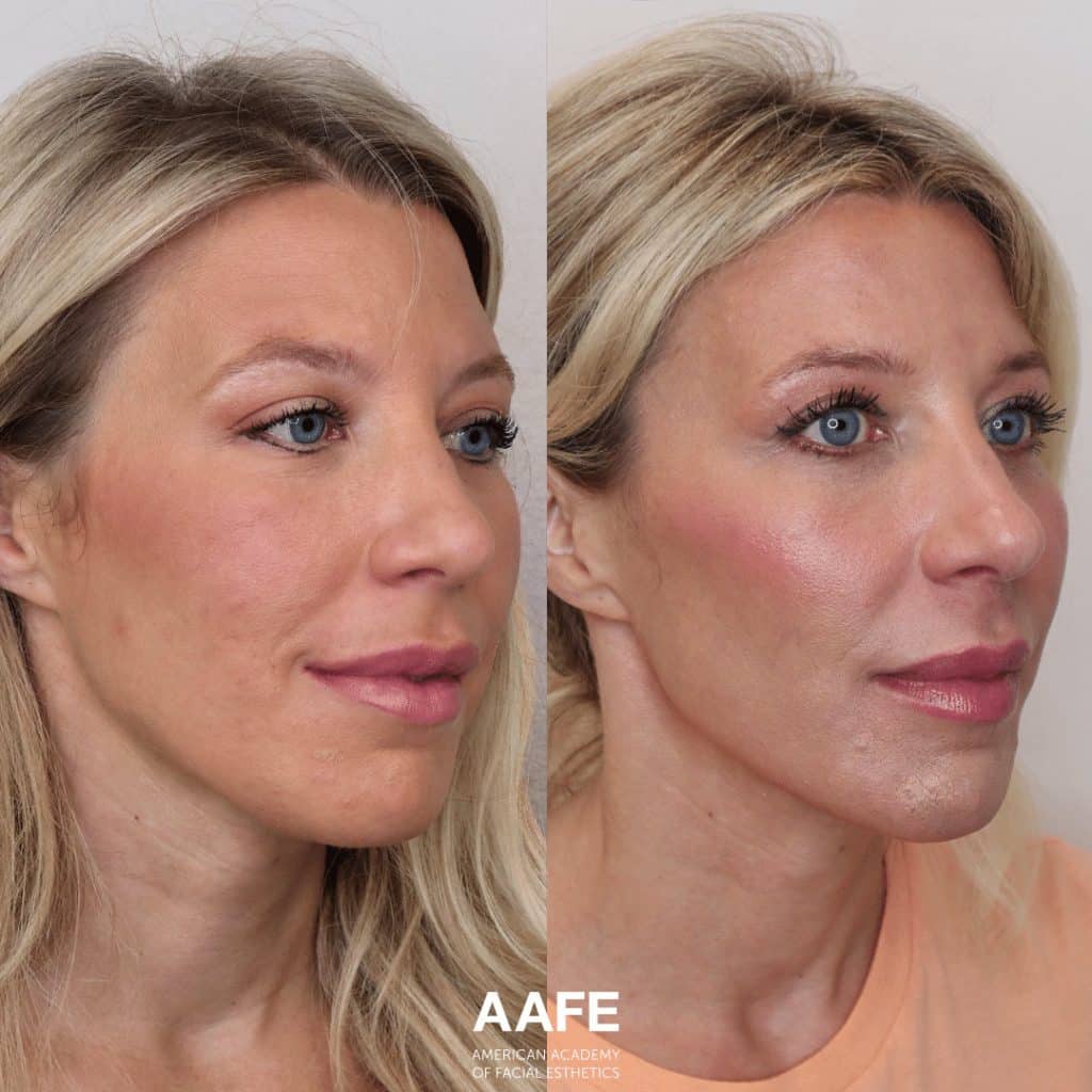 A Blond Haired Woman Shows The Before And After Affects Of Sculptra Treatment.