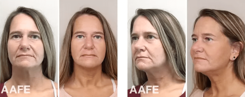 Aafe Masseter Botox Before And After Photos Showing Facial Contour Changes From Front And Side Angles