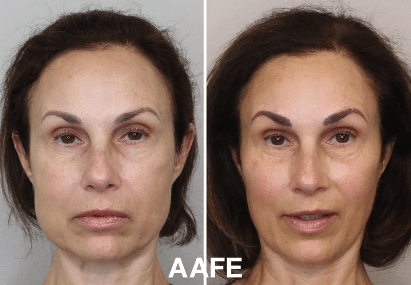 Aafe Masseter Botox Before And After Results Showing Jawline Slimming And Improved Facial Symmetry
