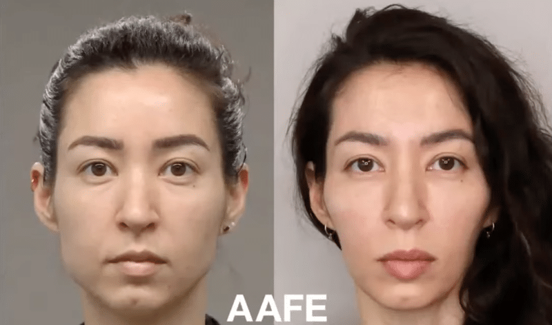 Masseter Botox Before And After Showing Slimmer Lower Face And Reduced Jawline Width After Treatment