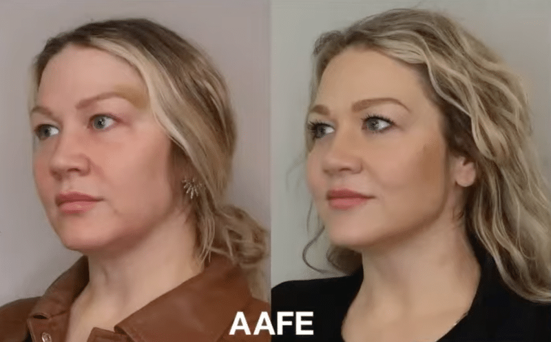 Masseter Botox Before And After Side Profile Showing Softer Jawline Contour And Improved Lower-Face Balance