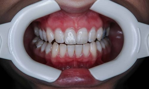 A Photo Of Teeth Grinding At The Dentist